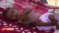بي بي سي:اليمن يواجه"أكبر مأساة إنسانية في العالم"(فيديو)