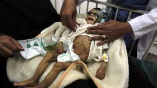 الغارديان:المجتمع الدولي سيواجه وضعا إنسانيا مأساويا غير مسبوق في اليمن