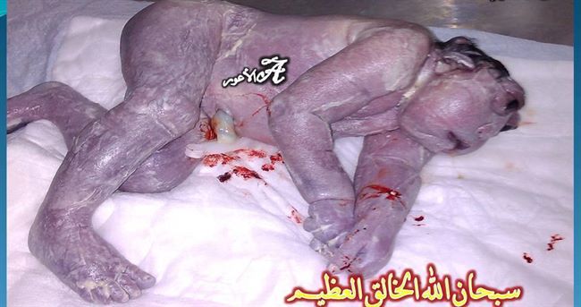 صورة لمولود مشوه على هيئة رجل كبير بالسن أنجبته امراة يمنية بصورة طبيعية