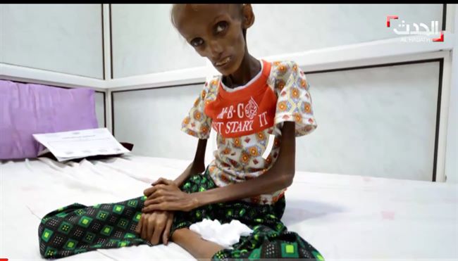 سعيدة..أول حالة مجاعة غذائية تسجل في اليمن..(صورة وتفاصيل)