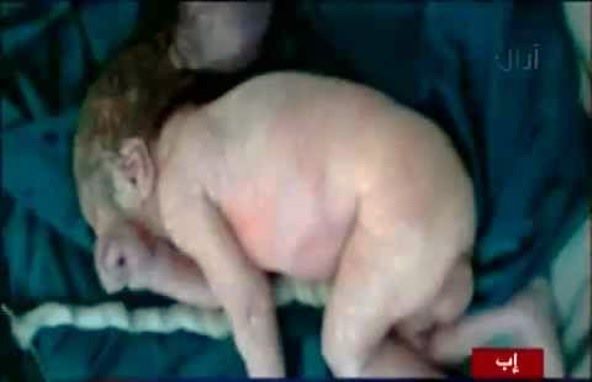بالفيديو.. ولادة طفلين يمنيين في أشكال غريبة 